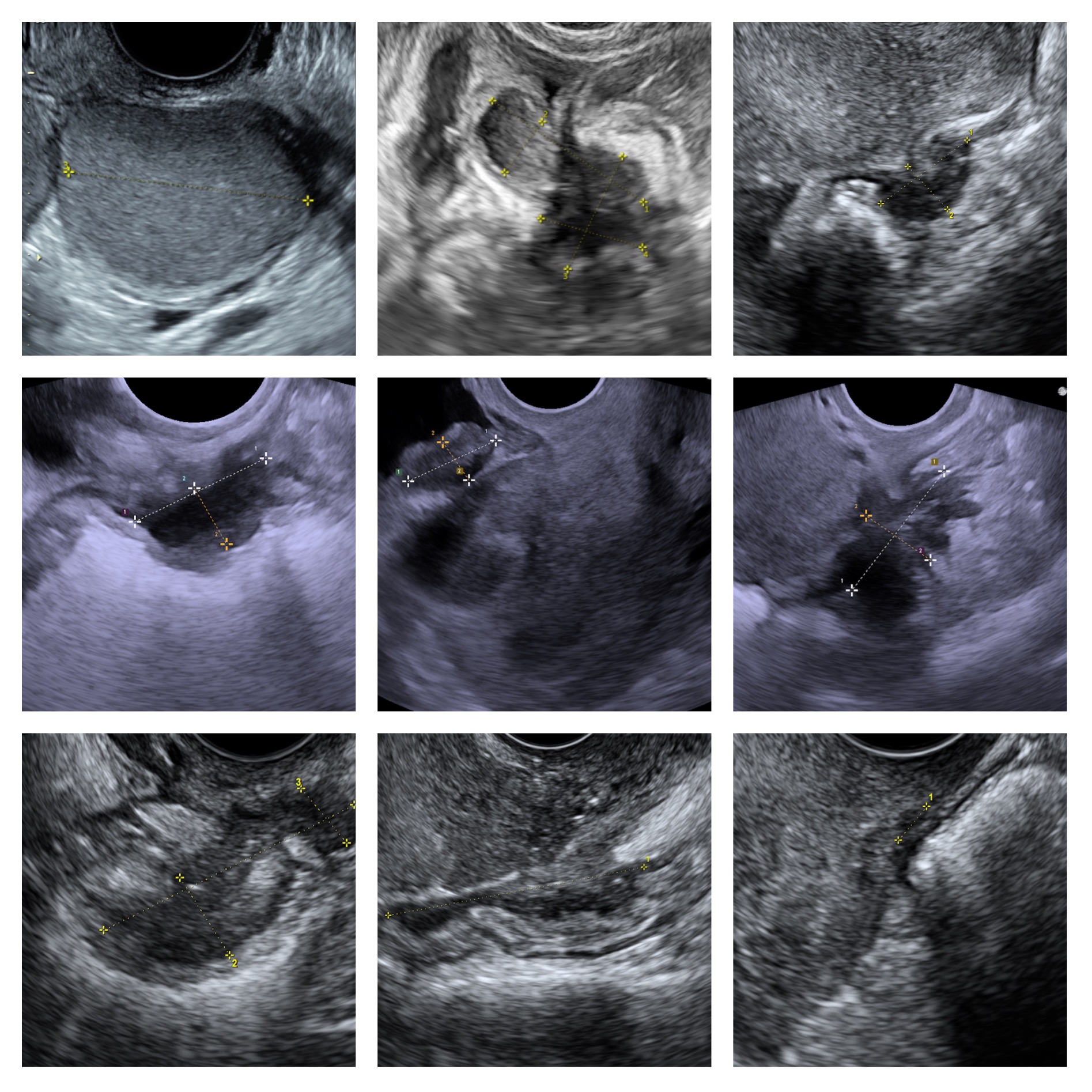 Endometriosis lesions visible during a transvaginal ultrasound